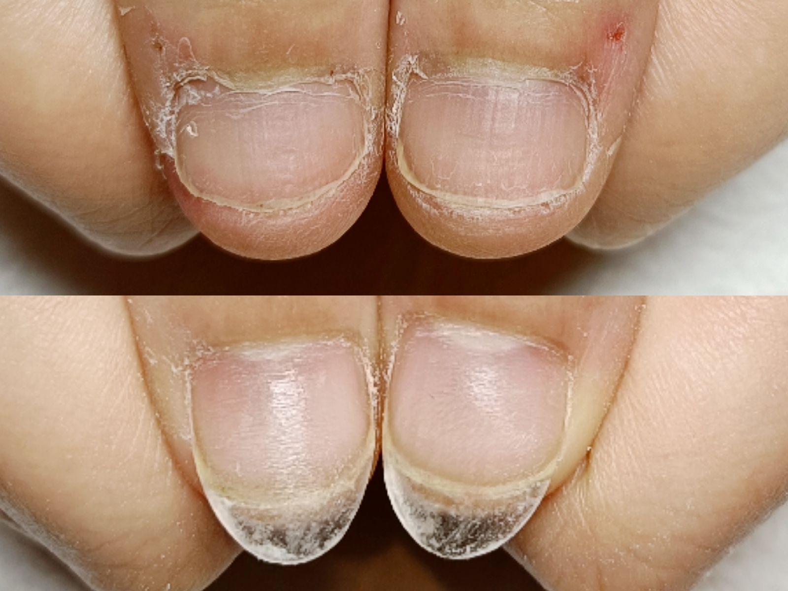 夏に向けて【深爪矯正】で深爪を美爪育成しませんか？