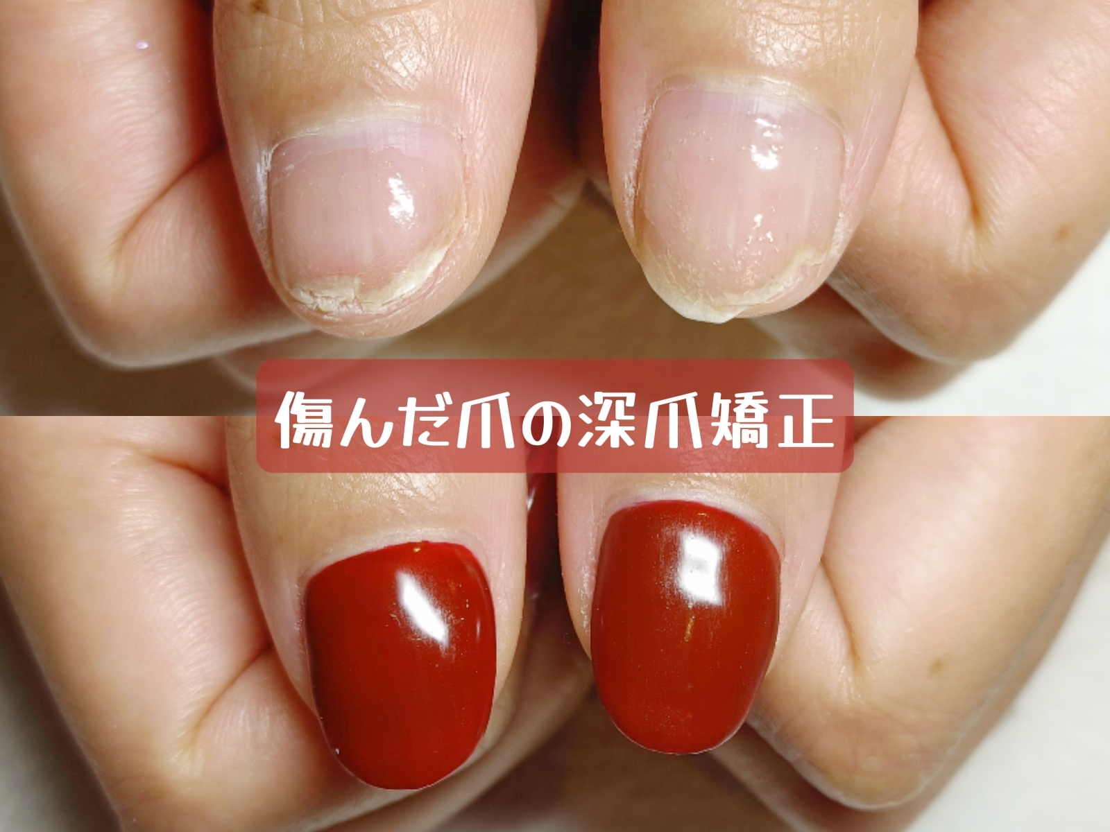 深爪矯正で変わる、自信の持てる自爪へ