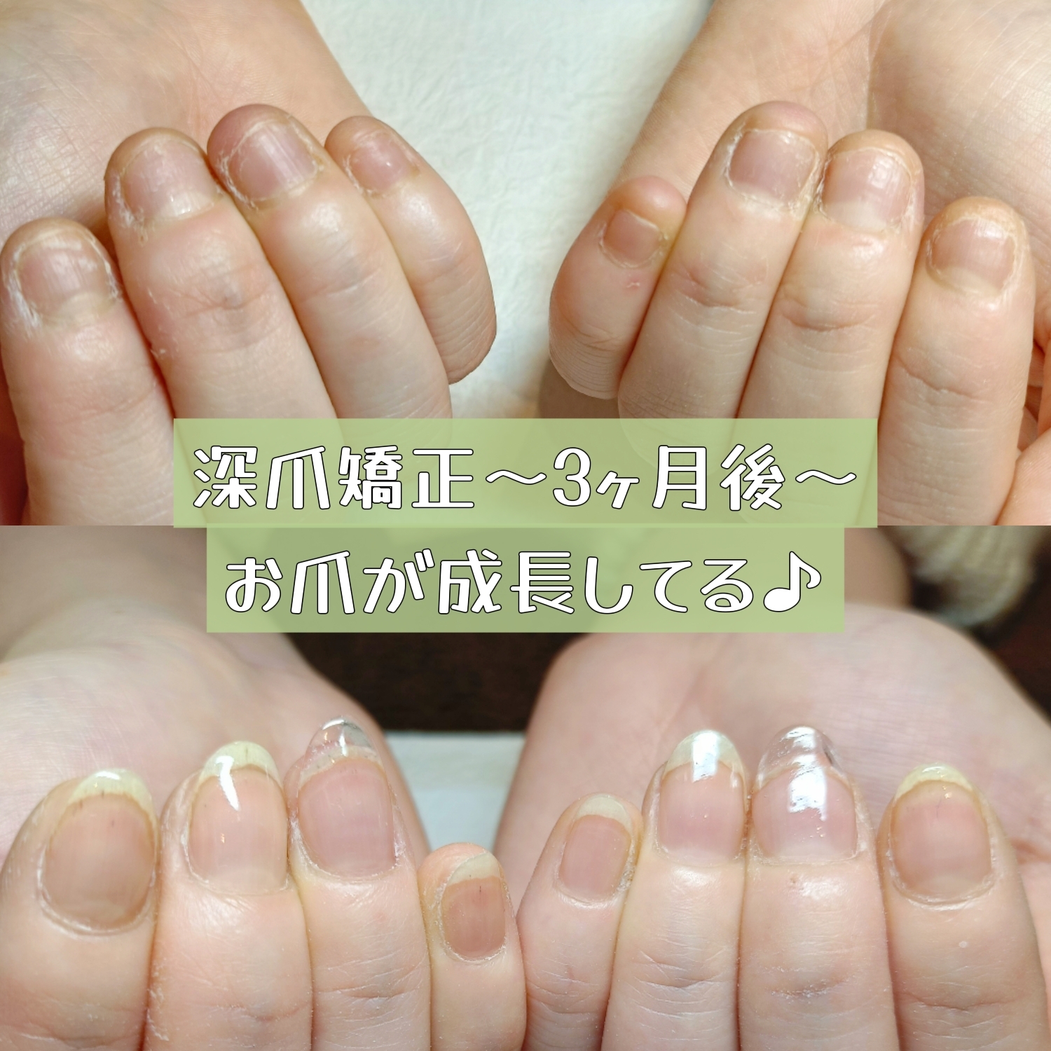 深爪は爪の問題だけではない？毎日忙しいが口癖の方へ