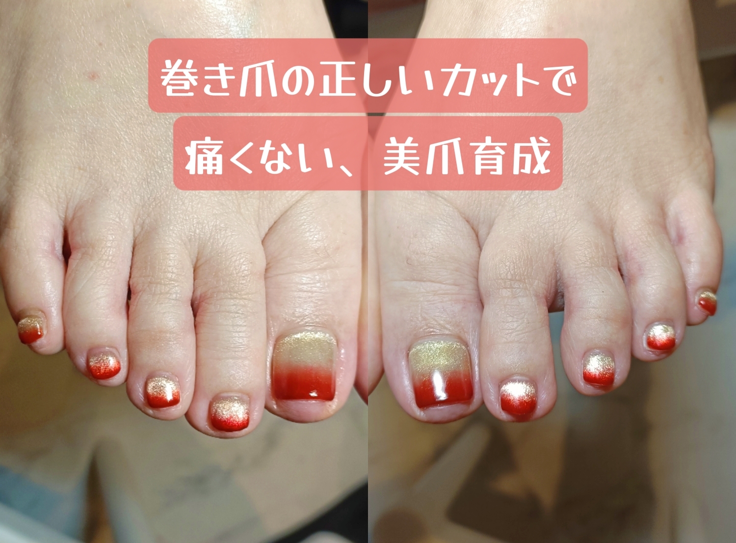 巻き爪の基本ケア、爪の切り方で変わる痛みと形の改善