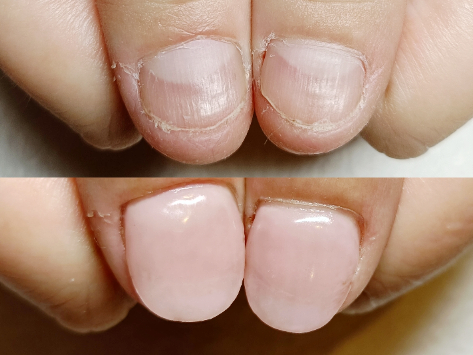 看護師さんでもOK！ナチュラルネイルで叶える深爪矯正ケア