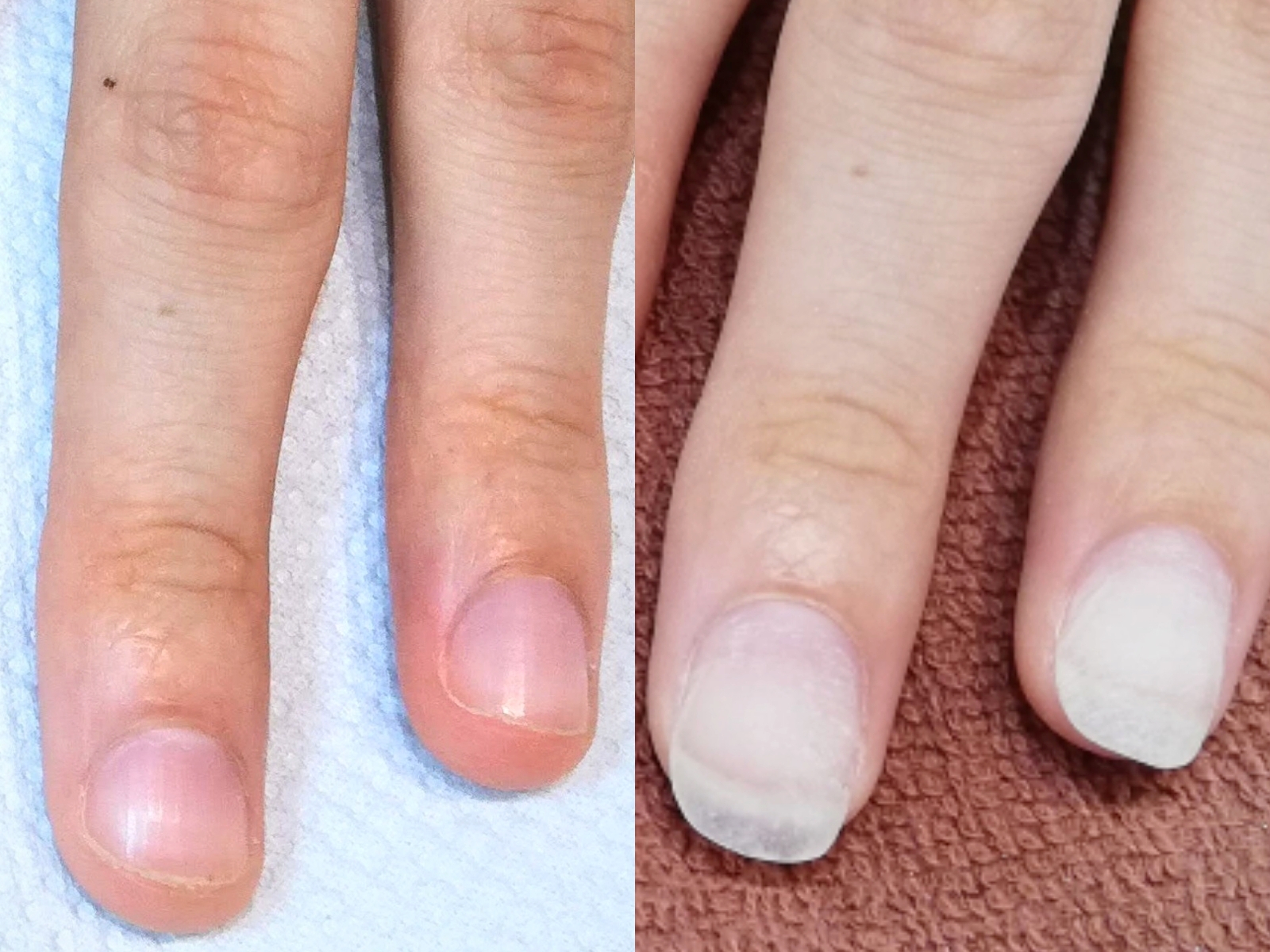 【1回目の深爪矯正】これから、3ヶ月の美爪育成がスタートします。