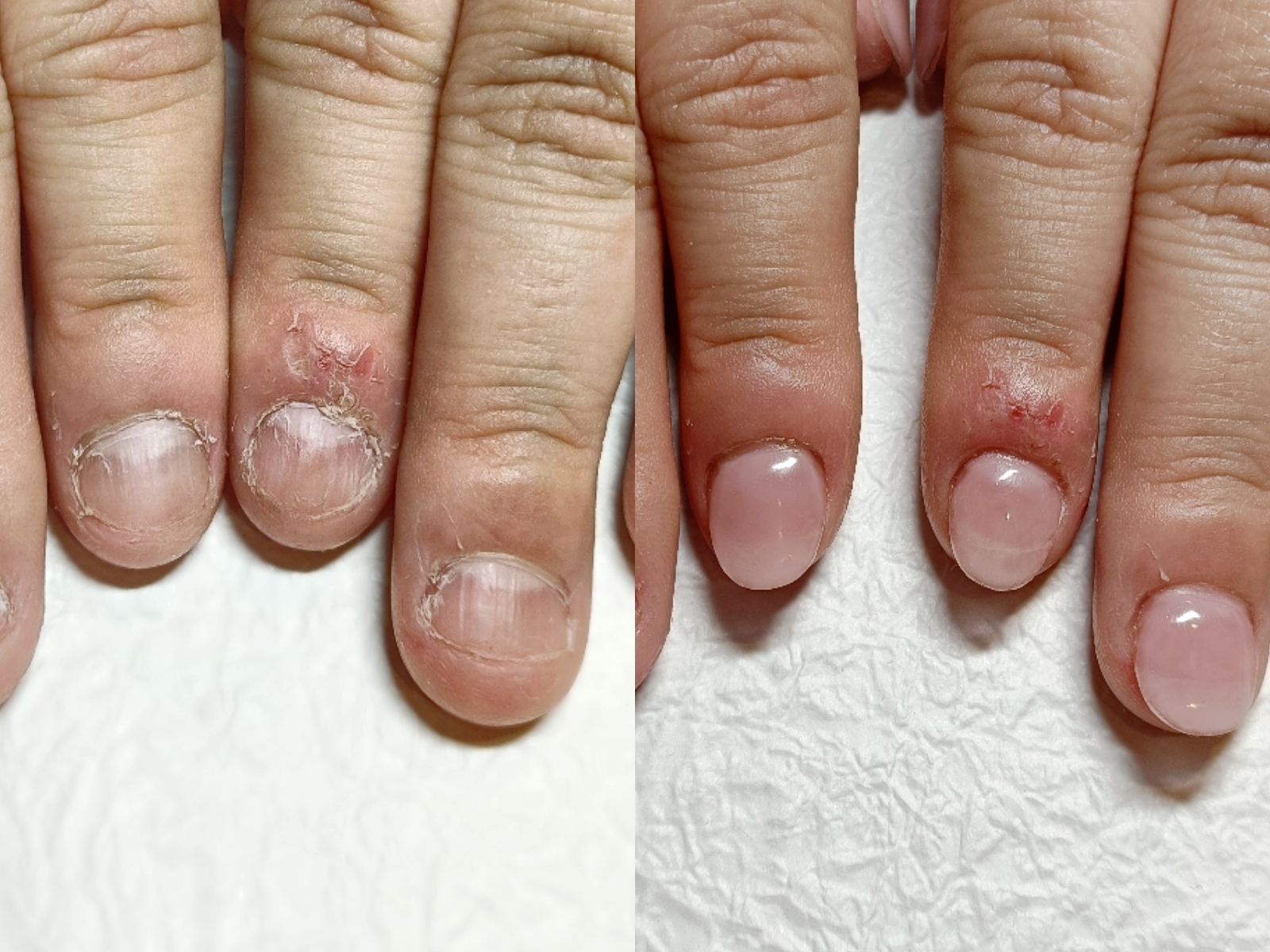 【深爪矯正はこんな方におススメ】傷んだお爪、薄い爪、自力で爪を伸ばせない方へ