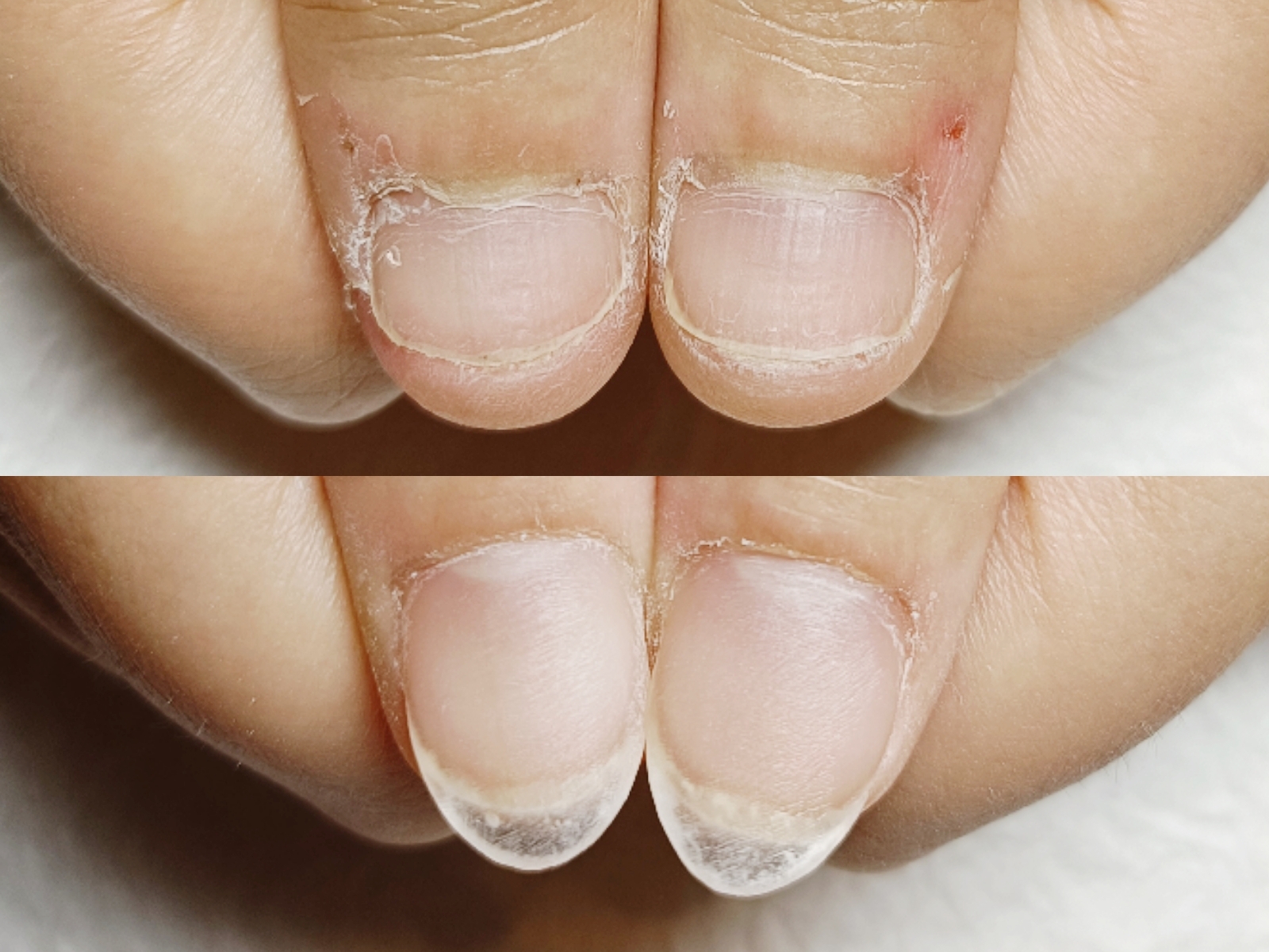 深爪矯正の長さ出しってどんな風に仕上がるの？